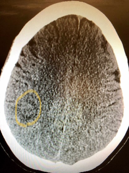 A brain scan of Tresa Spencer's brain shows exactly where her GBM was located.