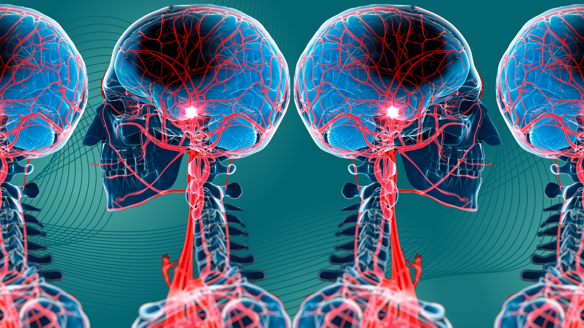 What is a stroke? - BrainWise Media